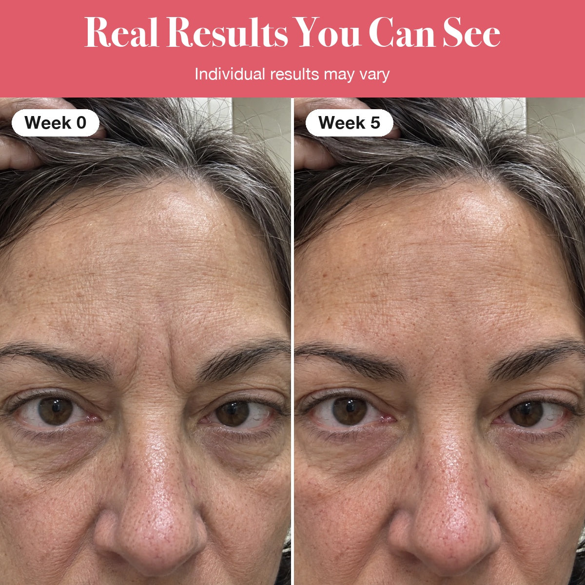 LumaLift™ Red Light Therapy Wand To Soften Frown Lines