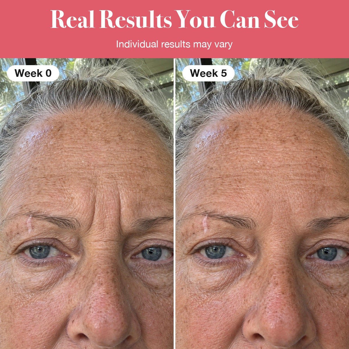 LumaLift™ Red Light Therapy Wand To Soften Frown Lines
