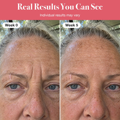 LumaLift™ Red Light Therapy Wand To Soften Frown Lines