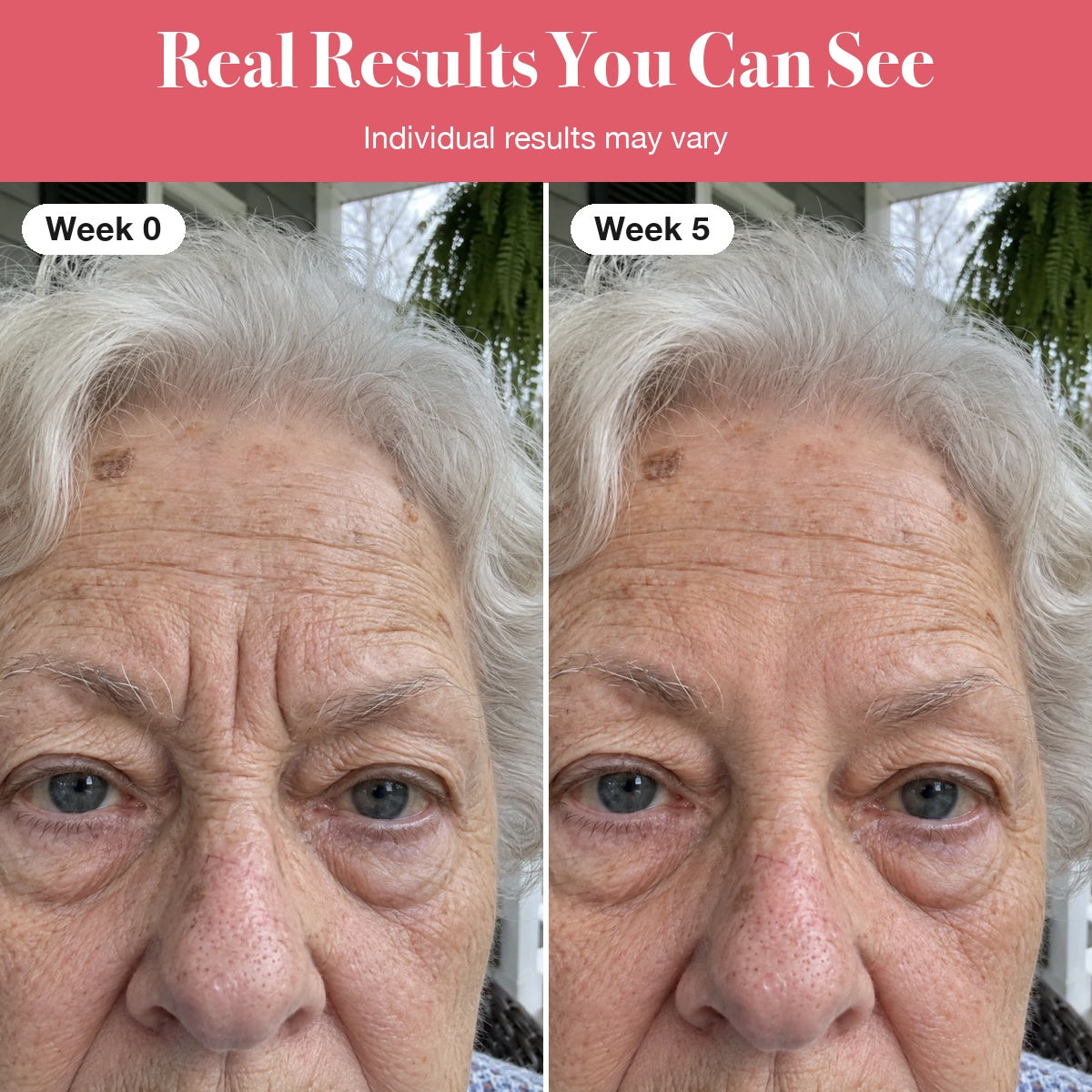 LumaLift™ Red Light Therapy Wand To Soften Frown Lines