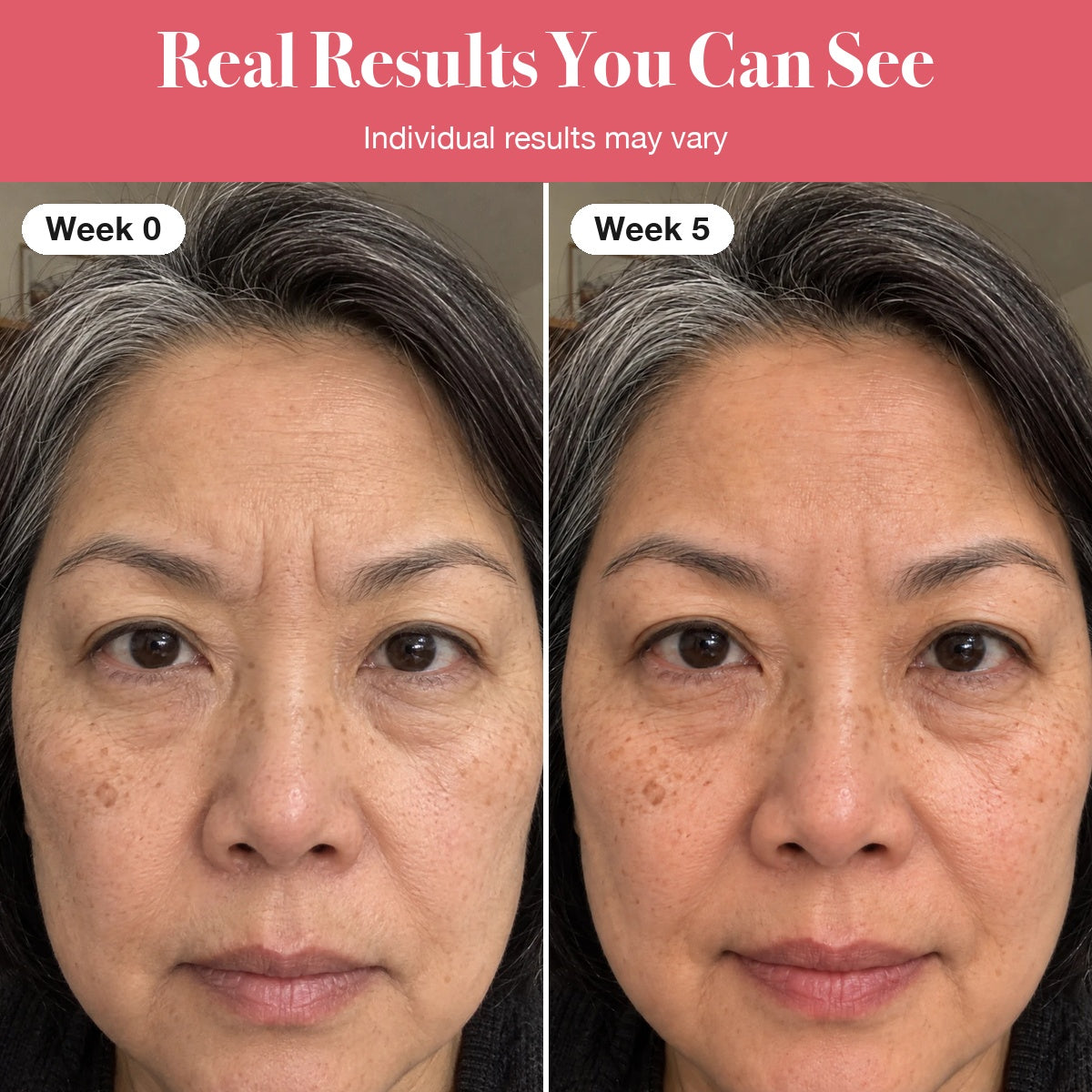 LumaLift™ Red Light Therapy Wand To Soften Frown Lines