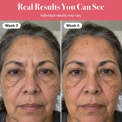 LumaLift™ Red Light Therapy Wand To Soften Frown Lines