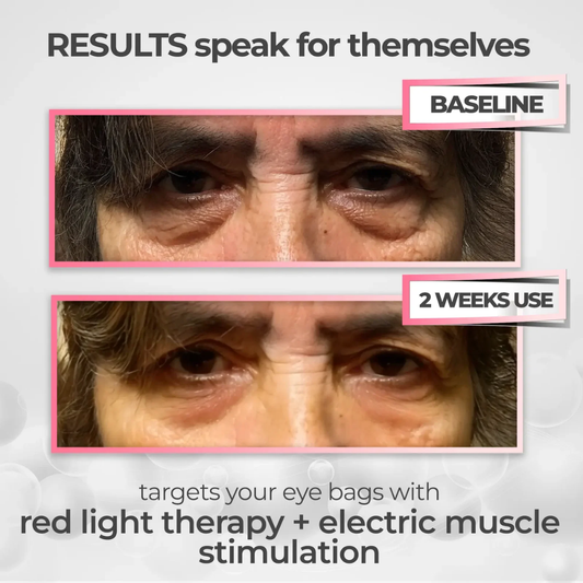 ReLumen® 2-in-1 Red Light Therapy + EMS To Erase Eye Bags