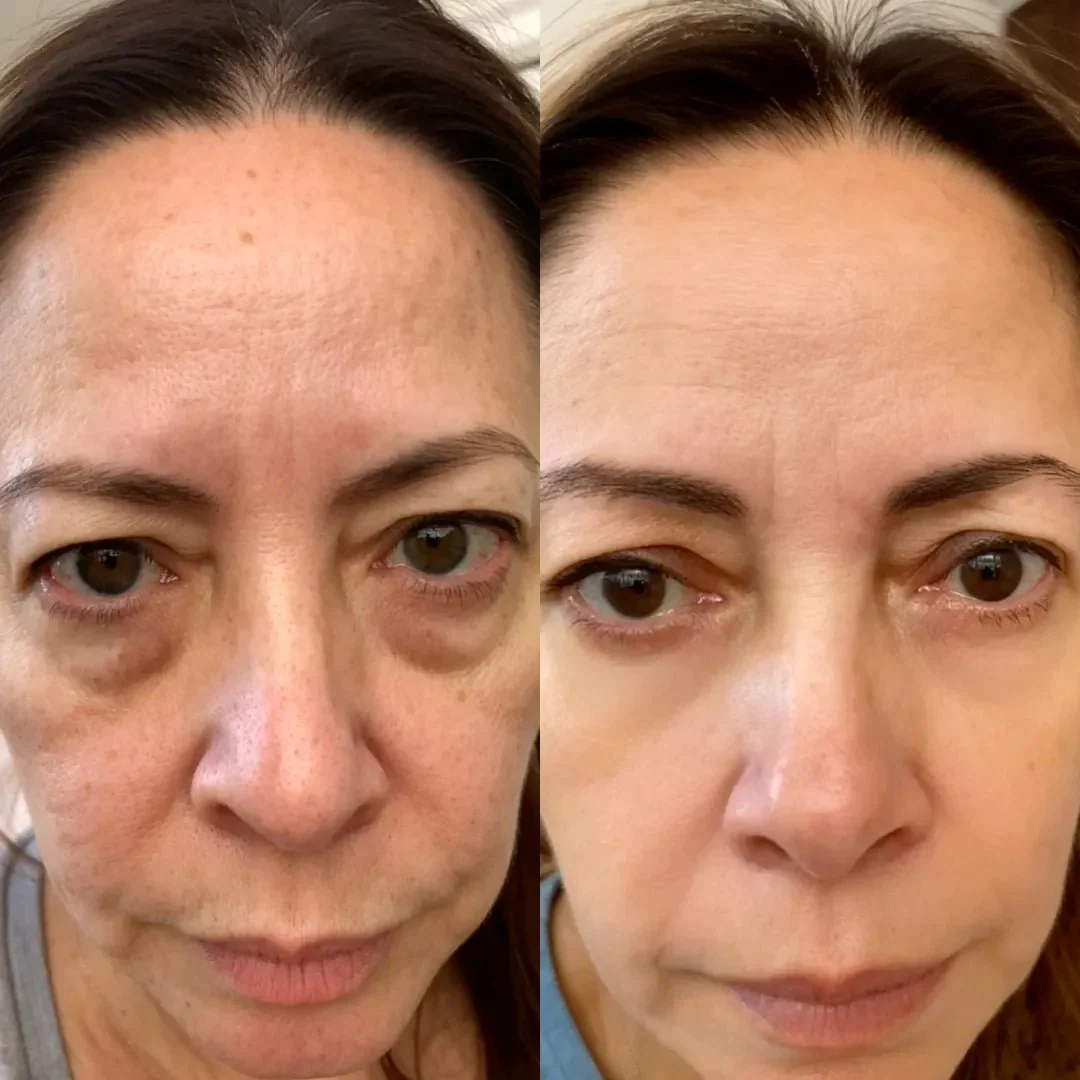 ReLumen® 2-in-1 Red Light Therapy + EMS To Erase Eye Bags