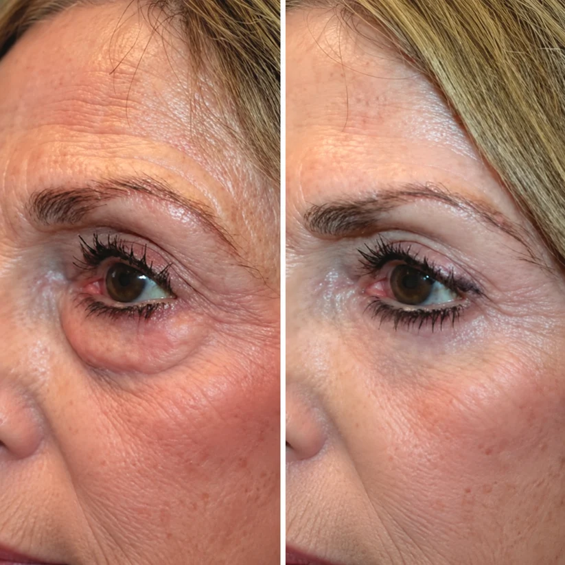 ReLumen® 2-in-1 Red Light Therapy + EMS To Erase Eye Bags